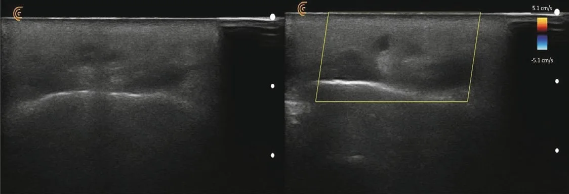 Fig 8. Aspecto ecográfico de un depósito de material en plano superficial, con y sin Doppler color.